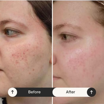 Zitcare-S Salicylic Acid Gel 1% w/w | Lightweight Acne Treatment for Oily Skin | Controls Oil, Reduces Redness & Prevents Acne Marks