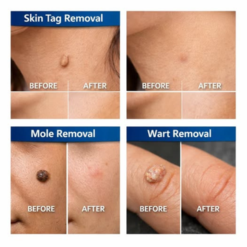 Glovure Mole & Wart Removal Cream – Targets Moles, Warts & Skin Tags – Safe & Gentle Formula – For Face, Neck & Body – Dermatologically Tested – All Skin Types